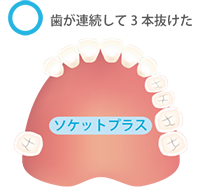 ソケット ソケットプラス